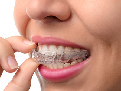 The image shows a person with clear braces, holding a small piece of food near their mouth.