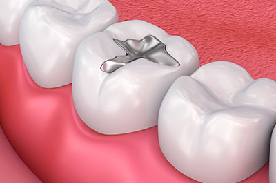 The image shows a close-up of a dental implant being inserted into a prepared tooth socket within a human mouth, with visible teeth on either side and a pink oral mucosa background.