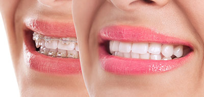 The image shows a person with a wide smile, displaying their teeth, against a white background.