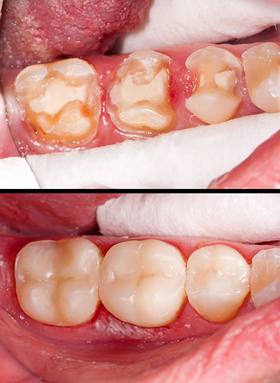 The image shows two photos of a person s mouth with teeth that appear to be decayed or damaged, likely for dental health education or treatment planning purposes.