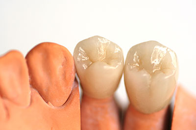 The image shows a set of dental implants with artificial gums and teeth, displayed against a white background.