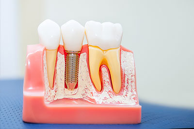 An image displaying a dental model with artificial teeth and gums, showcasing various dental implants and fixtures.