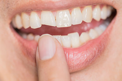 An adult human mouth with teeth showing, holding a finger between the teeth, smiling broadly.