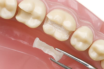 The image shows a close-up view of a dentist s work area with a tooth being prepared for a dental procedure, featuring a drill bit inserted into the tooth, and a small piece of material removed from the tooth.