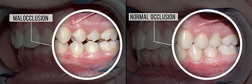 The image shows two photographs side by side of a person s mouth with teeth before and after treatment, labeled  Malocclusion  and  Normal occlusion,  respectively.