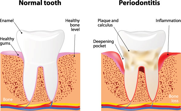 The image is a medical illustration showing different stages of tooth decay progression from normal to periodontitis, with annotations pointing out healthy bone, a cavity, and advanced gum disease with loss of bone structure around the teeth.