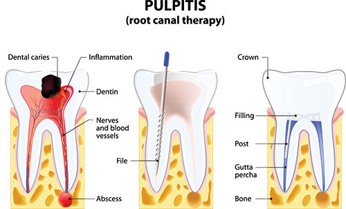 The image shows a diagrammatic representation of a dental implant procedure with annotations indicating various stages such as  root canal therapy ,  dental caries ,  inflammation ,  crown ,  filling , and  abscess . It also illustrates the use of a blue tool, likely for cleaning or drilling, within the tooth structure.