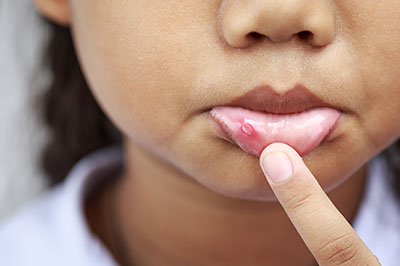 The image shows a close-up of a young individual s face with a focus on their lips, which appear to be affected by some form of irritation or condition, such as chapped or cracked skin.