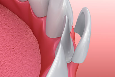 The image shows a close-up view of a dental implant with multiple prongs inserted into a pinkish gum, against a blurred background.