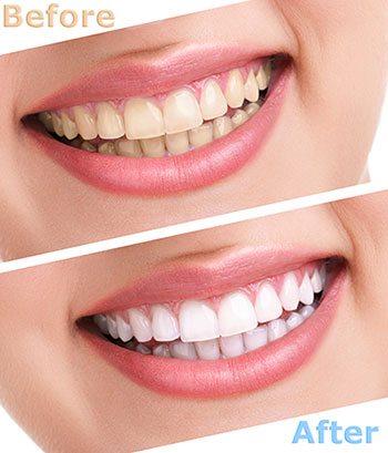 The image shows a smiling person s teeth before and after dental treatment, with a text overlay indicating improvement after the procedure.