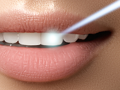 The image features a close-up of a person s lips with a focus on their teeth, set against a blurred background, likely for promotional or product display purposes.